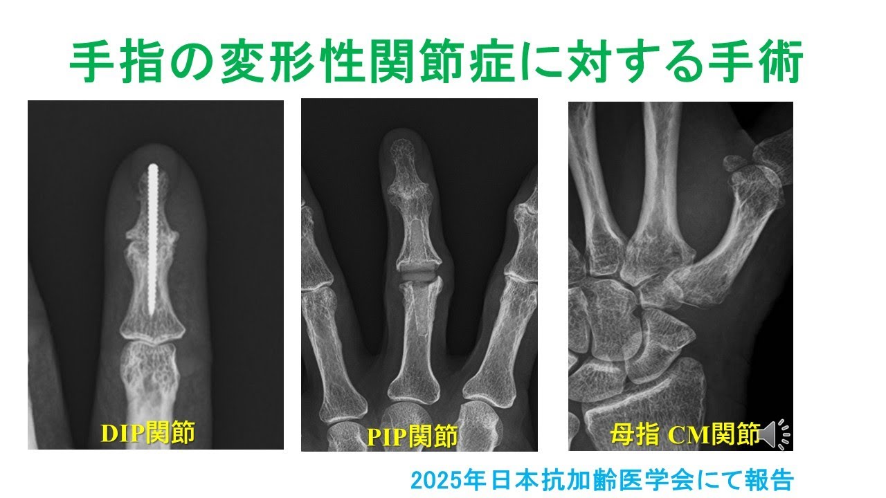手指の変形性関節症に対する手術 （2025.6 日本抗加齢医学で報告