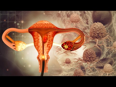 Video: Diagnóstico Del útero En Silla De Montar: Cómo Quedar Embarazada