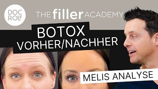 BOTOX VORHER/ NACHHER ERFAHRUNGEN & ANALYSE – TFA by doc.rolf
