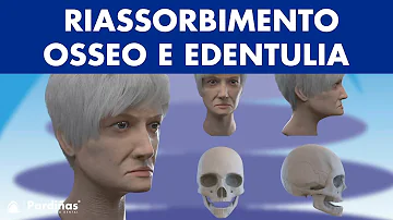 Cosa vuol dire edentulia totale?