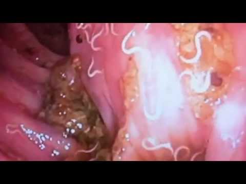 eltávolítás a pinworms ból sürgős segítség férgeknél