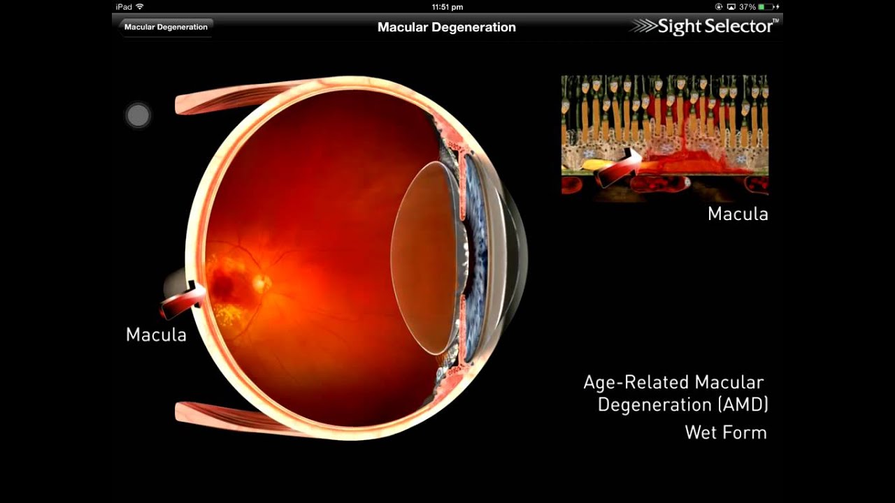 Macular degeneration YouTube