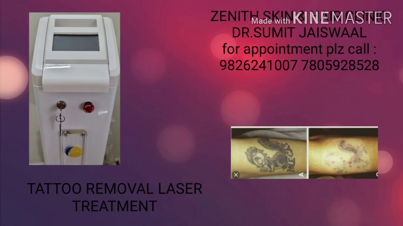 TATTOO REMOVAL LASER TREATMENT ZENITH SKIN & HAIR CLINIC IN INDORE - YouTube