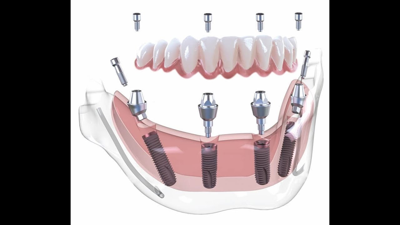 Имплантация sup aznona com. Имплант зуба Osstem. Протезы на имплантатах по технологии all-one-4 all-one-6.
