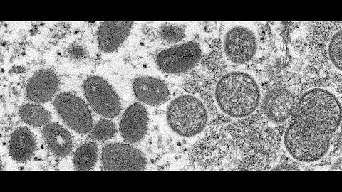 Presumptive Case of Monkeypox Virus in King County – PUBLIC HEALTH INSIDER