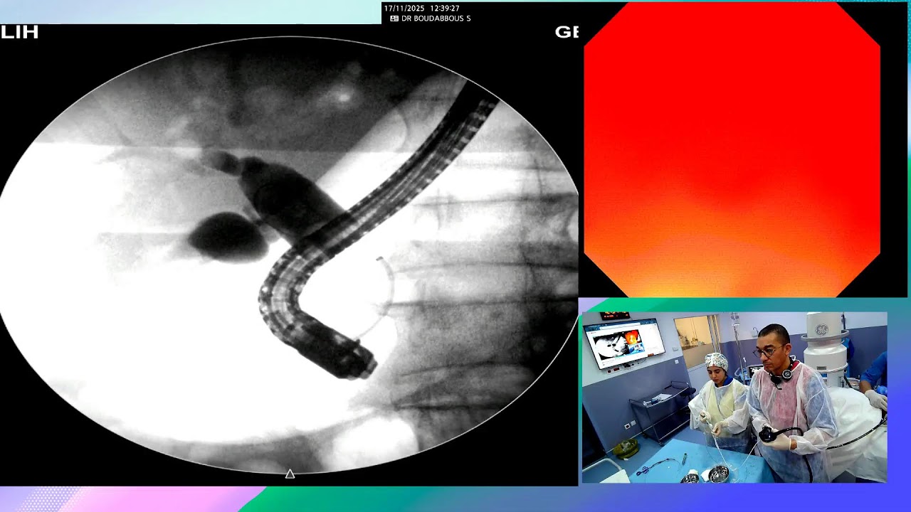 ERCP for acute cholangitis with liver abcess