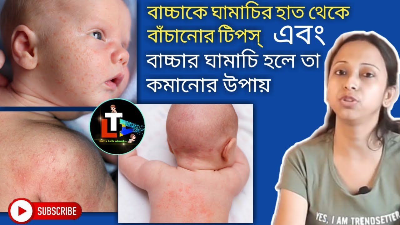 Baby Prickly Heat Rash and Home Remedies bacha der ghamachi komanor upay Summer Baby Care
