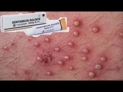 Mengobati Folikulitis (Bisul) dengan menggunakan Salep antibiotik