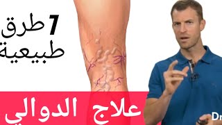 (( أسباب دوالي الساقين وطرق علاجها ب7  طرق طبيعية  ((  مترجم بالعربي