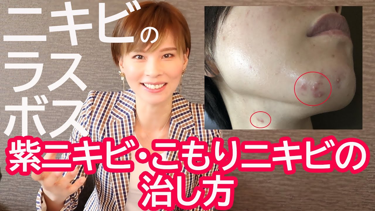 ニキビのラスボス！紫ニキビ・こもりニキビ・しこりニキビ（粉瘤）を治す唯一の方法とは？