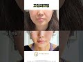 리프팅은 하고 싶은데 안면거상은 부담이 된다면 40분 만에 리프팅 되는 꼬집리프팅!