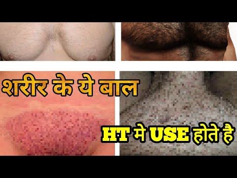 Video BODY HAIR TRANSPLANT TO HEAD - AGE AND QUALITY OF BODY... - youtube