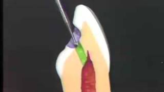 Endodontic Cavity Preps Phase 1  Occlusal & Lingual Opening