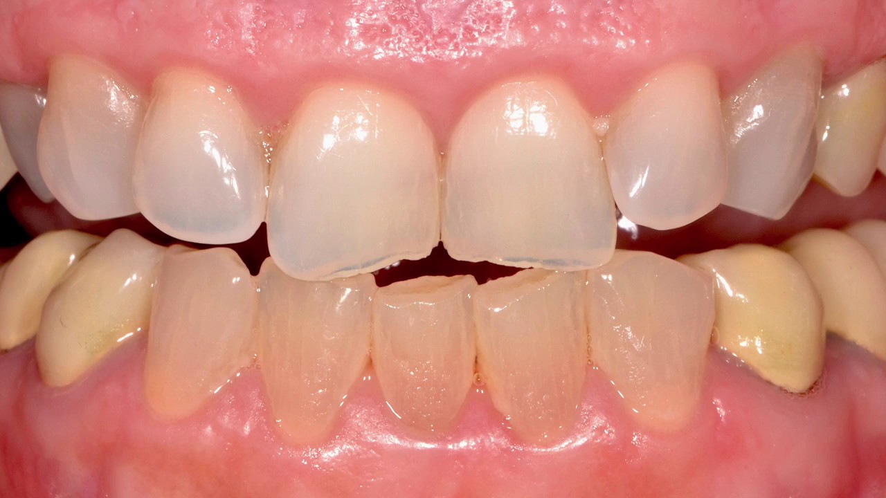 The BFEP composite veneers YouTube