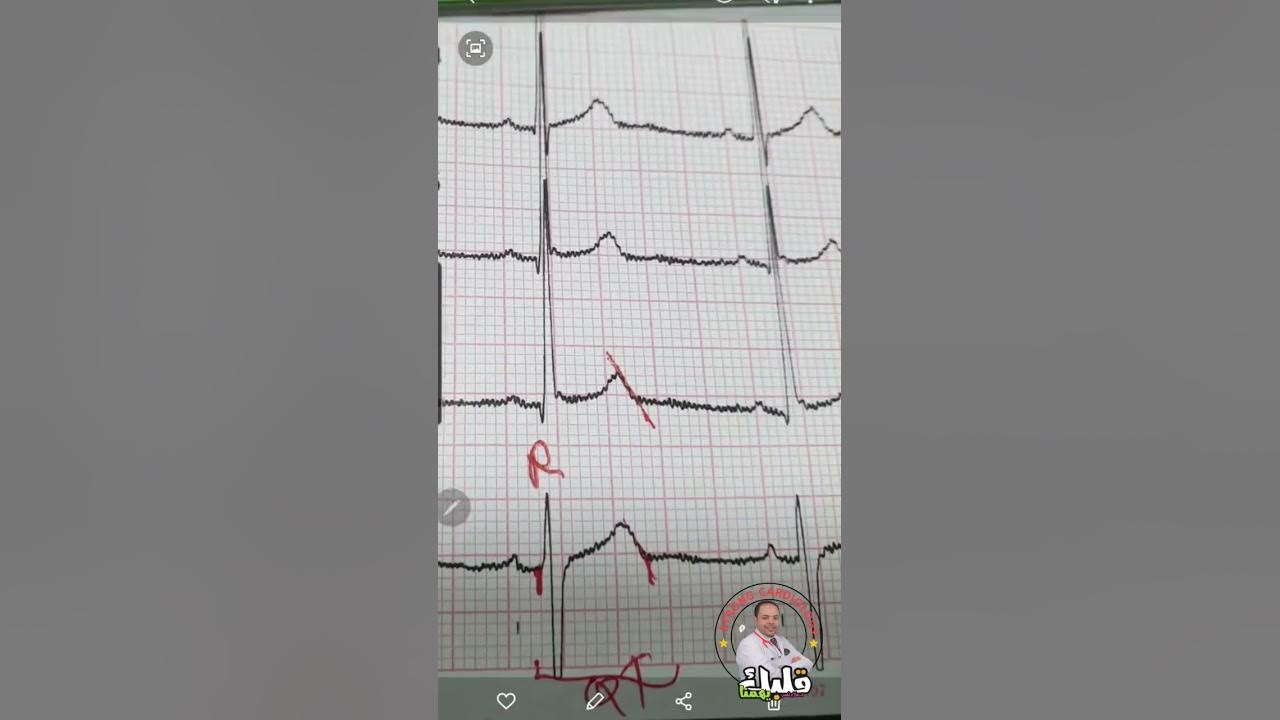 How to calculate QTc in esconds, Dr Alaa Nasr YouTube