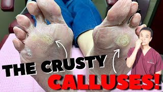 CRUSTY Callus Removal on BOTH Feet!! | Kim Foot and Ankle Center