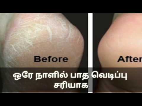ஒரே நாளில் பாத வெடிப்பு சரியாக(how To Get Rid Of Foot Crack In Tamil/ Foot Crack Remedy InTamil.