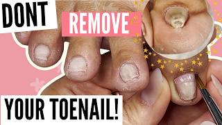 How to Reverse Pincer Toenail Reversal NO Podiatrist Needed