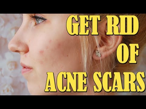 How to Get Rid of Acne Scars Fast And Naturally Overnight