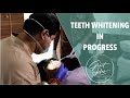 Teeth Whitening in Progress | Bleaching | Cosmetic Smile Makeover | Best Dental Clinic in Kolkata