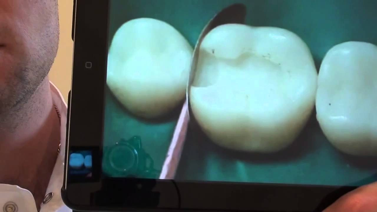 Особенности лечения кариеса.