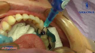 Восстановление зуба 4.4.(Стекловолоконные штифты, стоматология., 2015-07-08T07:11:29.000Z)