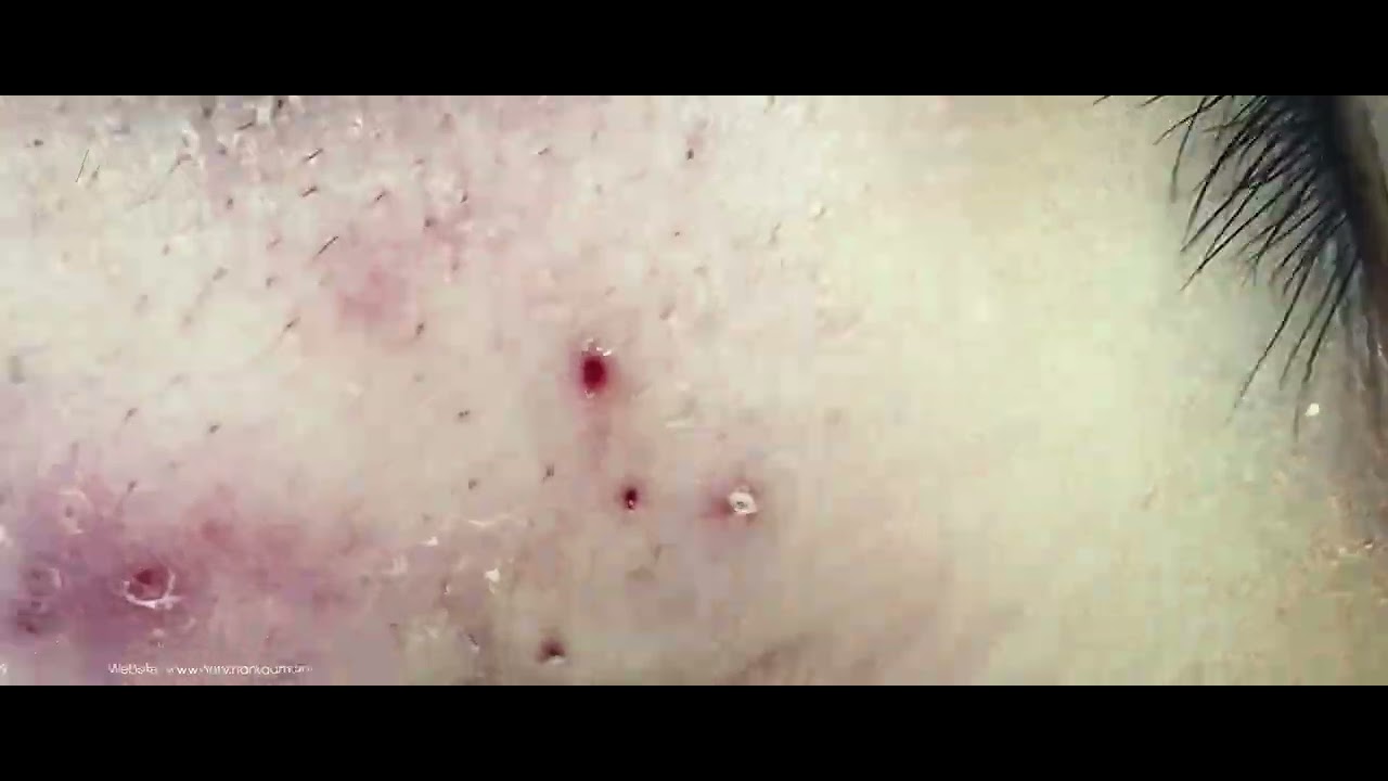 Big Cystic Acne Blackheads Extraction Blackheads & Milia, Whiteheads Removal Pimple Popping