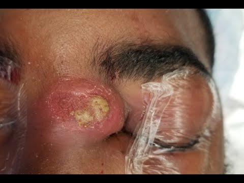 2 liters of PUS ? VERY VERY BIGGEST ABSCESS ? How surgery to drain Abscess infection ? CELLULITIS