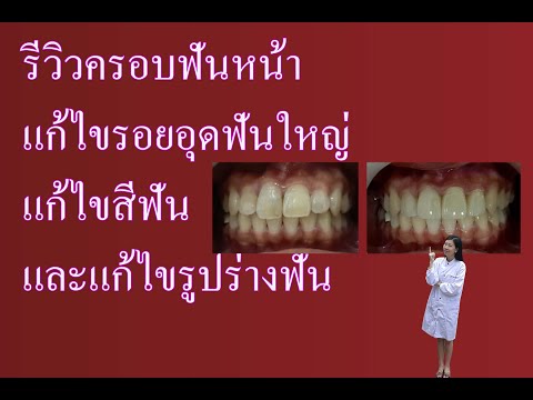 รีวิวครอบฟันหน้าแก้ไขรอยอุดฟันใหญ่,แก้ไขสีฟัน,และรูปร่างฟัน