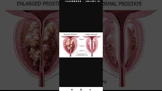 #prostateenlargement_benign hypertrophy of prostate gland #ayurvedacure #02882755321