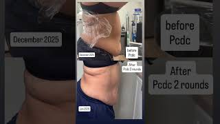 #fatdissolver #dissolving #pcdc#kybella #fupa#backfat #glowup #bra#summer2026