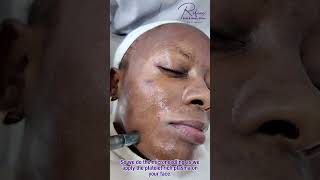 Microneedling + PRP treatment is performed on a client at our Bukoto branch. #microneedling