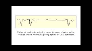 50 Pacemaker Malfunction