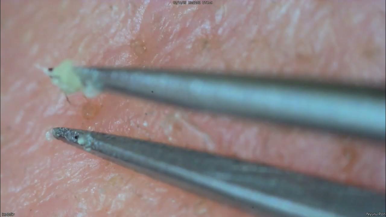 0139 keratin plug removal nose YouTube