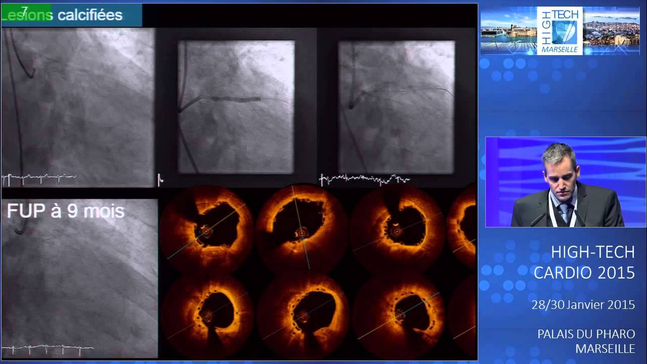 Stents biorésorbables : Peut-on faire les lésions complexes? camera iphone 8 plus apk