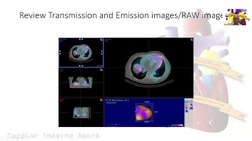 Recognizing and Correcting Motion Artifacts on SPECT