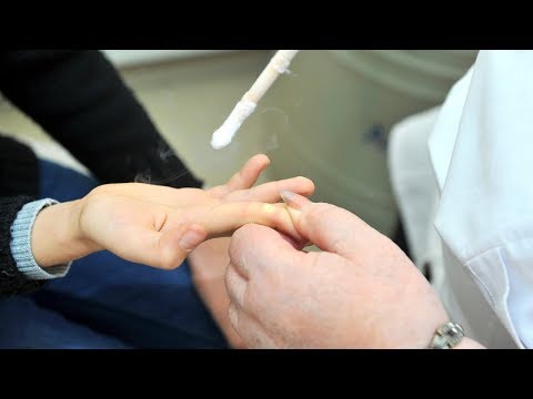 Как прижигают бородавки детям