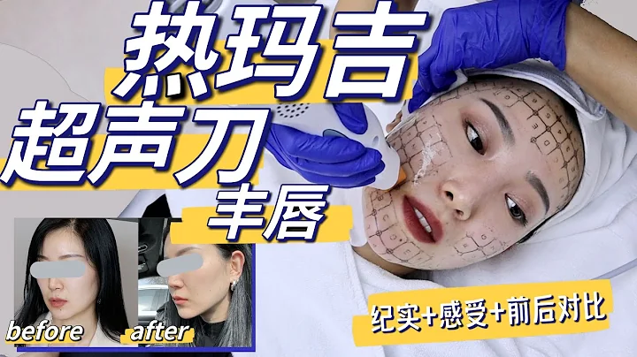 熱瑪吉/超聲刀/豐唇｜2個月後真實感受｜值不值？多少錢？「ENG SUB」Ultherapy/Thermage/lip job Transformation After 2 Mo 這些人千萬別做! - 天天要聞