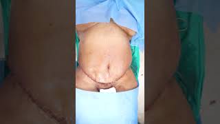 Tummy tuck surgery | Weight Loss shortvideoviral