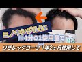 ミノキシジル5% リザレックコーワを4分の1の量で使用して1年2ヶ月〜プレマ家の買物