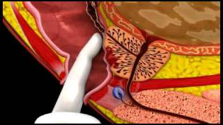 Prostate Cancer - 3D Medical Animation || ABP ©