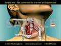 Anterior Cervical Fusion: 3D Medical Animation