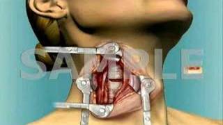 Anterior Cervical Fusion: 3D Medical Animation screenshot 4