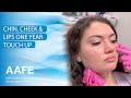 Chin, Cheek &amp; Lips One Year Touch Up