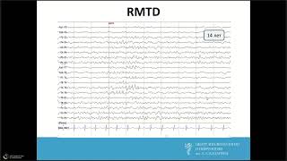 Троицкий А.А. Физиологические паттерны на Видео ЭЭГ