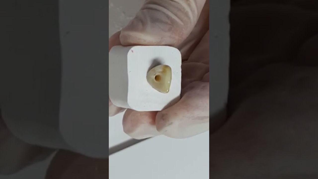 Üst orta keser diş giriş kavitesi demosu / Maxillary central incisor access cavity preparation