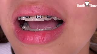 Braces checkup - getting rubber bands for the first time - Tooth Time family dentistry New Braunfels