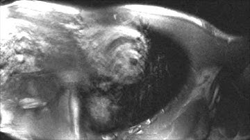 Respiratory motion artifact in cardiac cine MRI