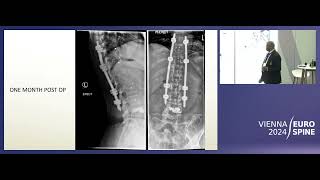 Metastasis Kumar Eurospine 2024