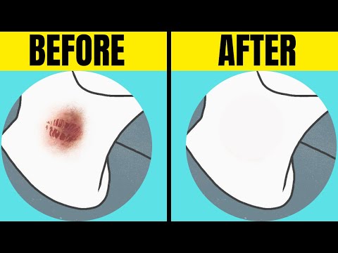 HOW to GET RID of Hickeys: PROVEN Removal Techniques !!